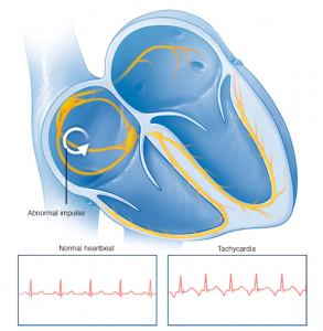 Tachycardia - Heart Beat Graphic Representation