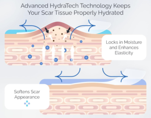 ScarScience Silicone Scar Sheets